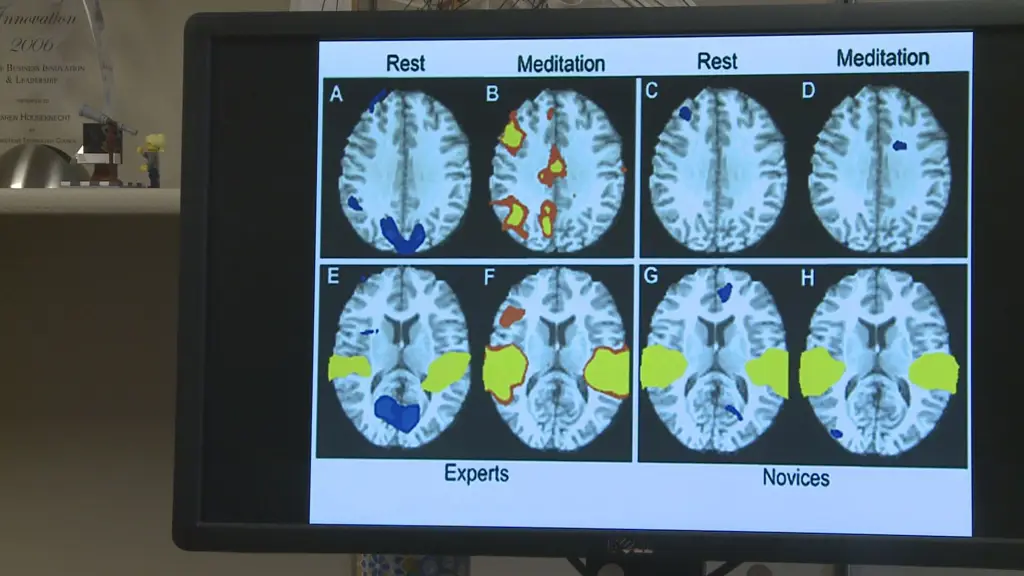 Gambar scan otak yang menunjukkan area yang terdampak kehilangan memori.