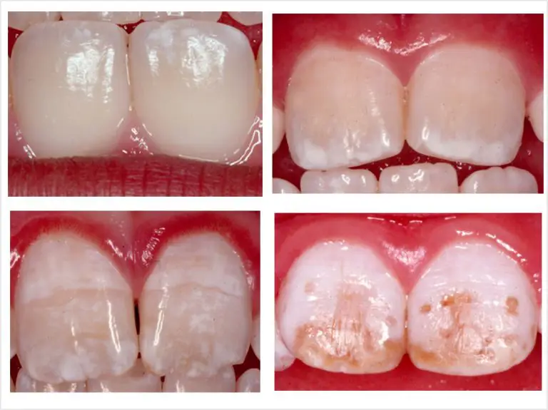 Gambar sebelum dan sesudah bleaching fluorosis