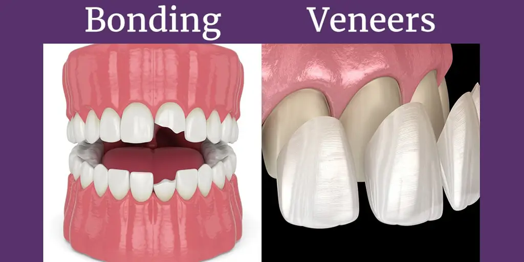 Perbandingan veneer dan bleaching gigi