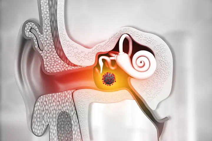 Ilustrasi peradangan pada telinga bagian dalam