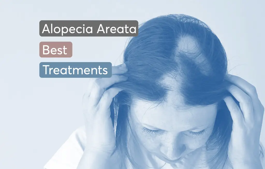 Gambar berbagai perawatan alopecia areata